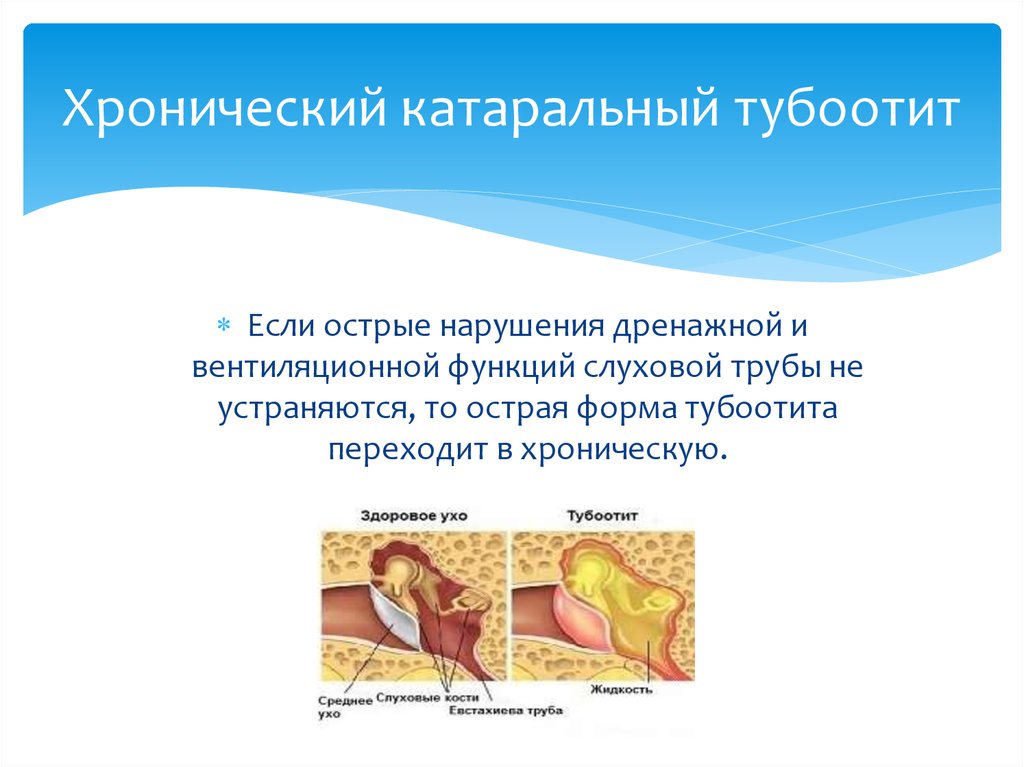 Тубоотит. Заболевания слуховой трубы. Острый катаральный тубоотит. Хронический катаральный тубоотит.