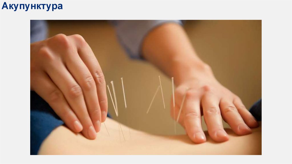 Акупунктура