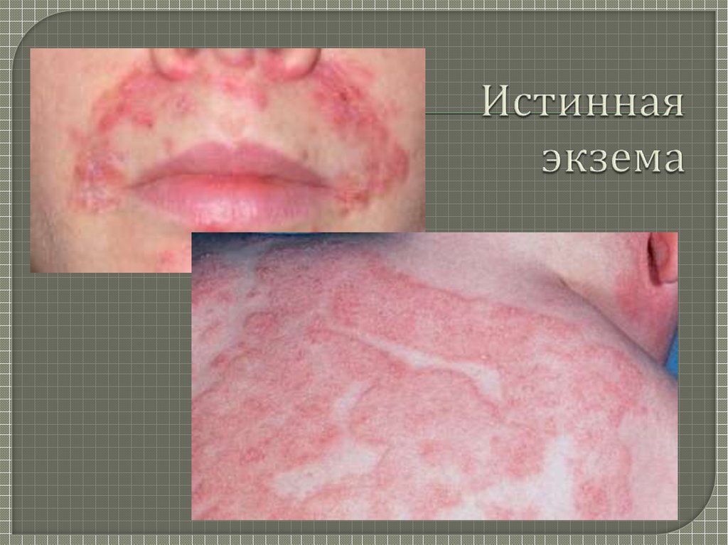 Экзема (eczema; греч. ekzema высыпание на коже) - презентация онлайн