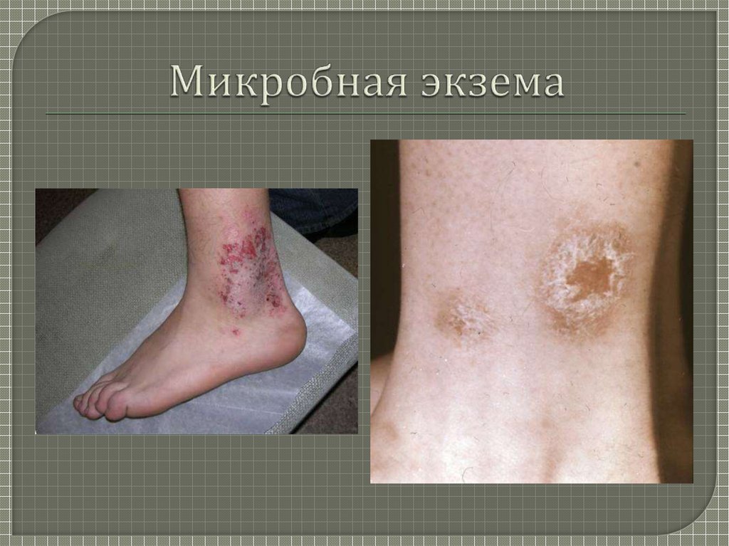 Экзема (eczema; греч. ekzema высыпание на коже) - презентация онлайн