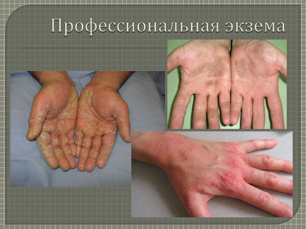 Экзема (eczema; греч. ekzema высыпание на коже) - презентация онлайн