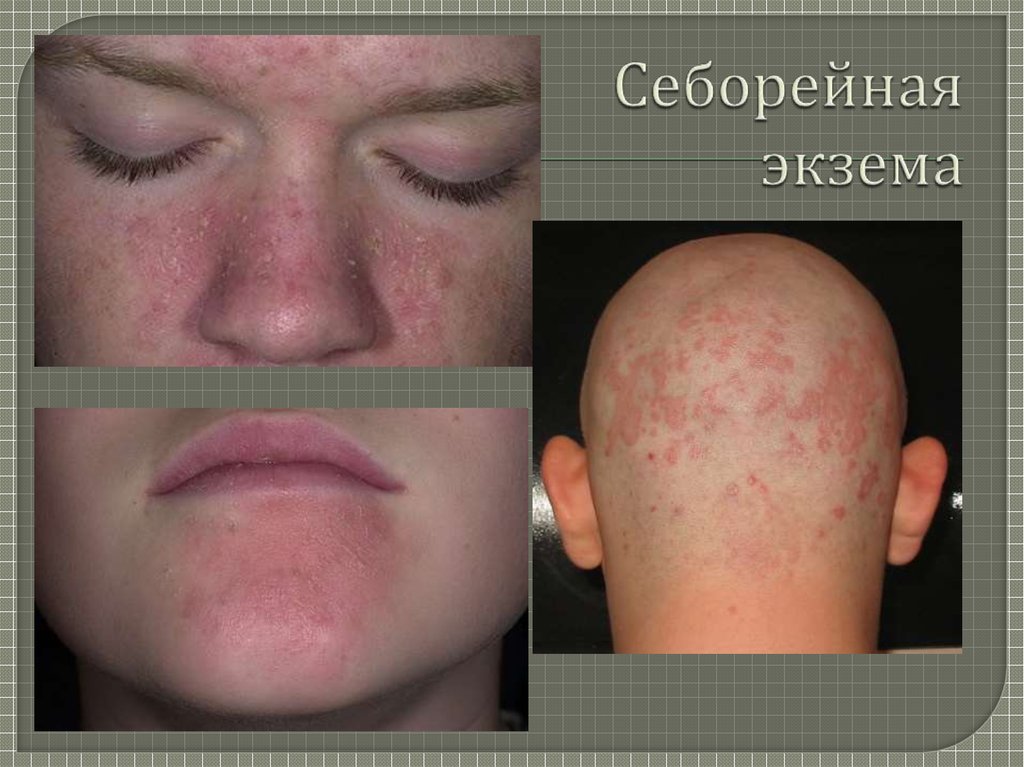 Себорейная экзема