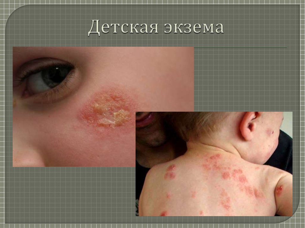 Экзема (eczema; греч. ekzema высыпание на коже) - презентация онлайн