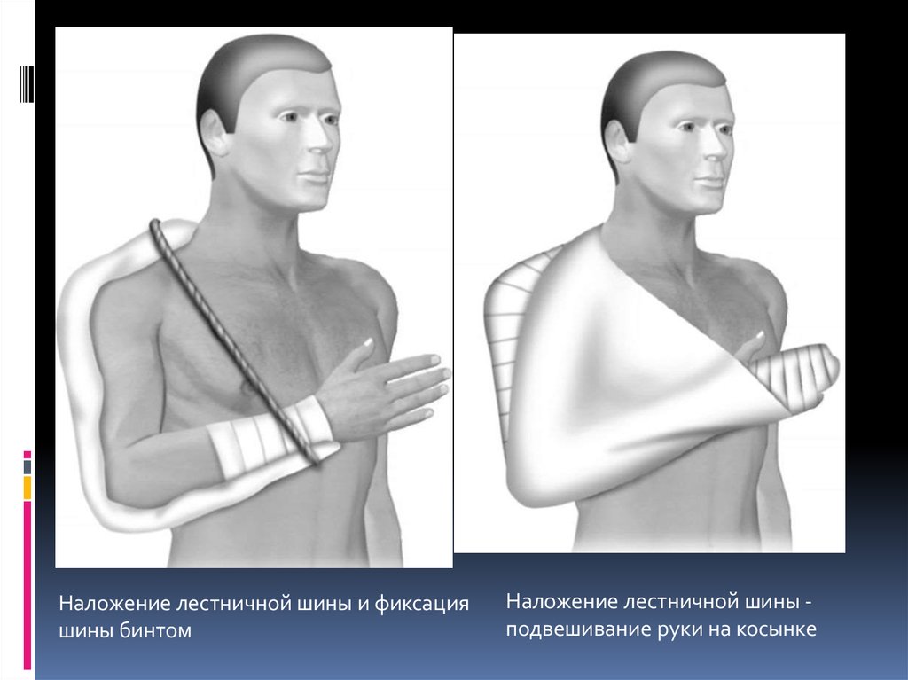 Транспортная иммобилизация при переломе ключицы. Шина при переломе ключицы. Иммобилизация верхней конечности. Подвешивание руки на косынке. Наложение лестничной шины.