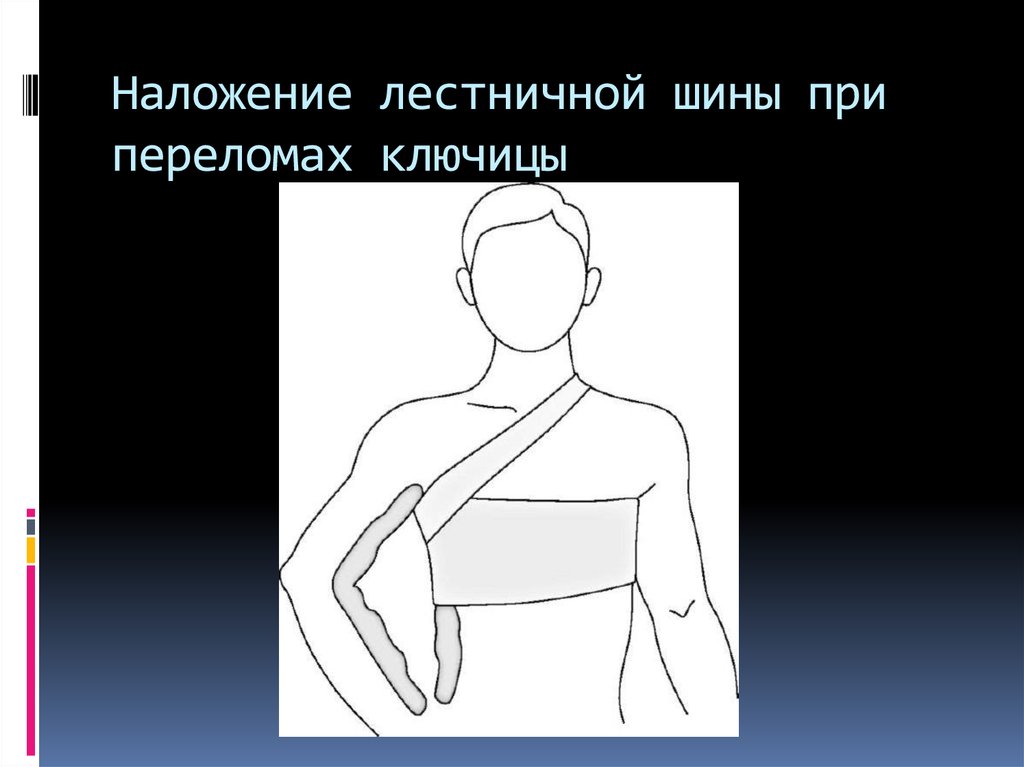 Оказание первой помощи при переломе ключицы. Перелом ключицы шина Крамера. Шина при переломе ключицы. Шина при переломе КЛЮЧТЦ. Наложение шины при переломе ключицы.