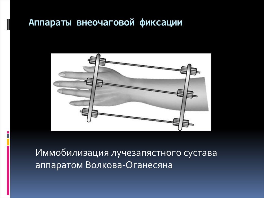 Операция остеосинтез. Аппараты внеочаговой фиксации. Иммобилизация лучезапястного сустава аппаратом Волкова-Оганесяна. Аппараты внешней фиксации при внеочаговом остеосинтезе. Аппарат внешней фиксации на лучезапястный сустав.