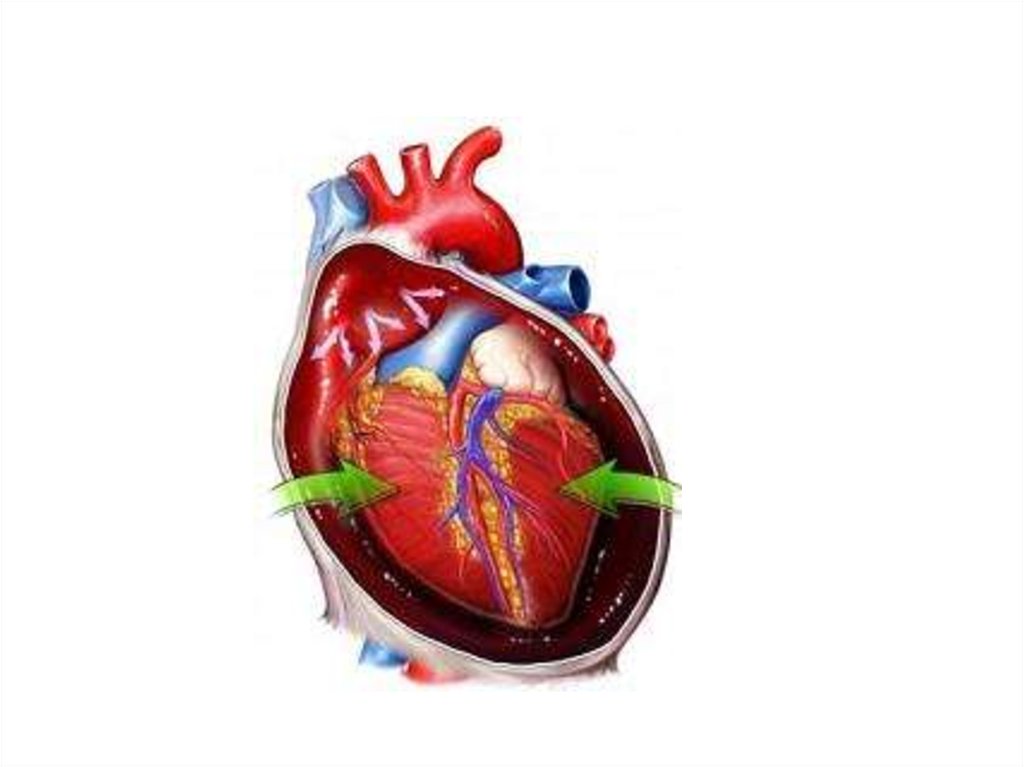 Скопление воздуха и крови в перикарде. Разрыв миокарда с тампонадой сердца. Тампонада полости перикарда.