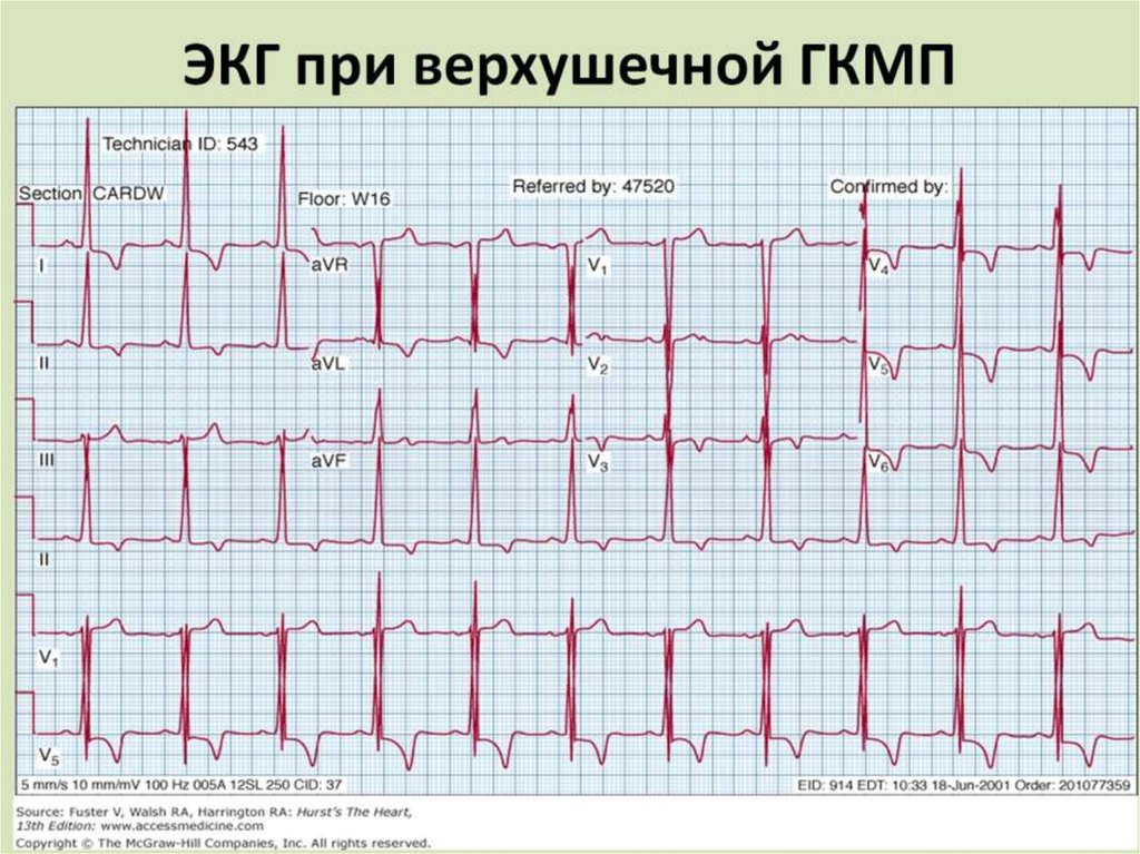 ЭКГ при верхушечной ГКМП