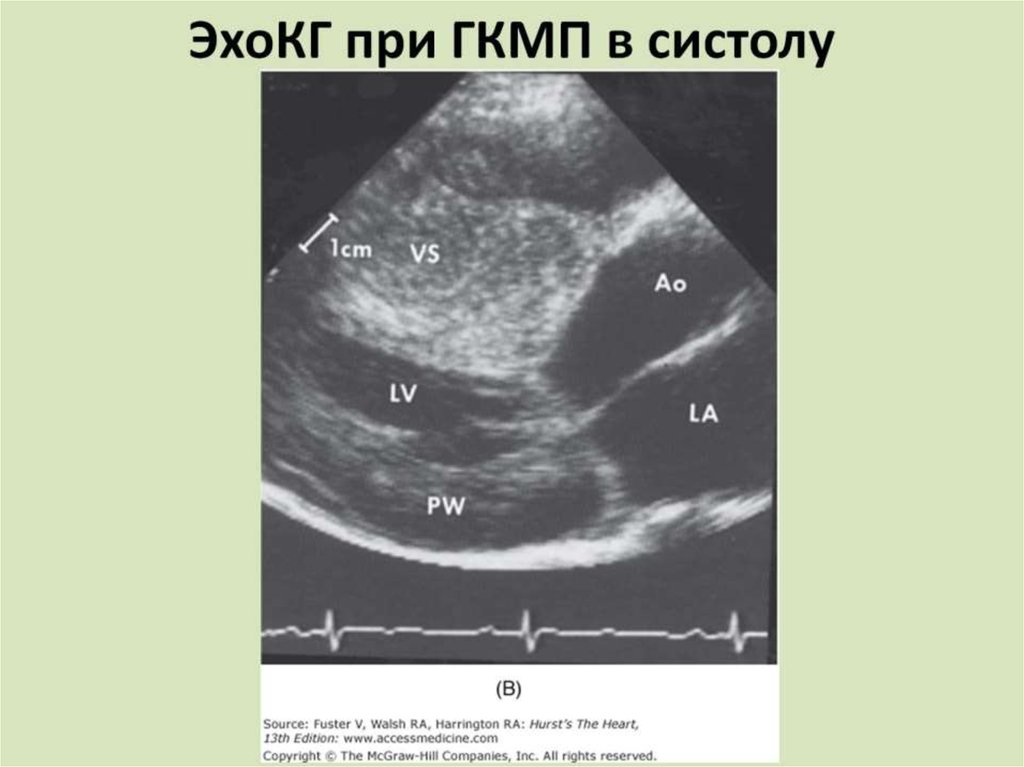 ЭхоКГ при ГКМП в систолу