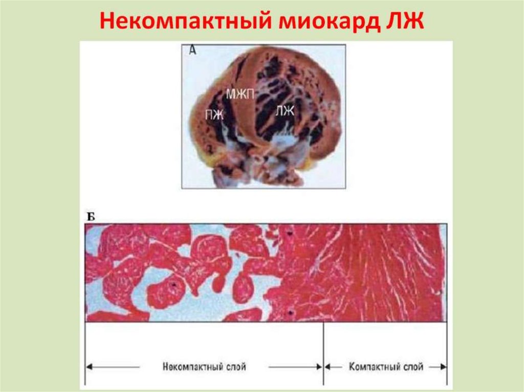 Некомпактный миокард ЛЖ