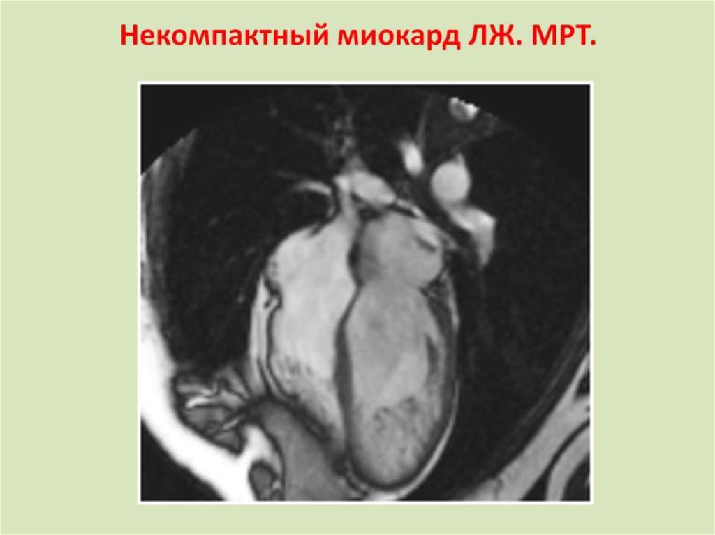 Некомпактный миокард ЛЖ. МРТ.