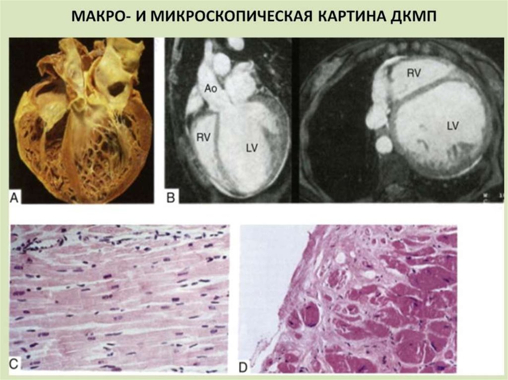 МАКРО- И МИКРОСКОПИЧЕСКАЯ КАРТИНА ДКМП