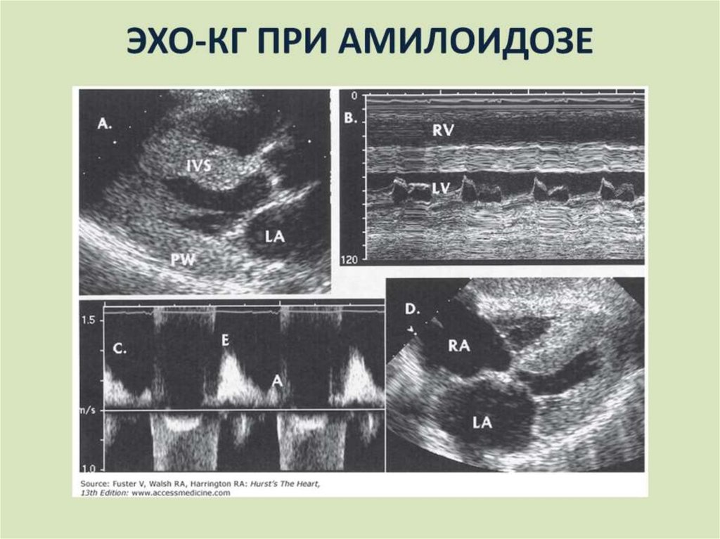 ЭХО-КГ ПРИ АМИЛОИДОЗЕ