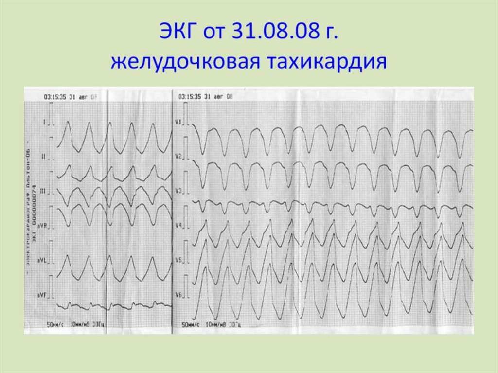 Желудочковая тахикардия экг фото