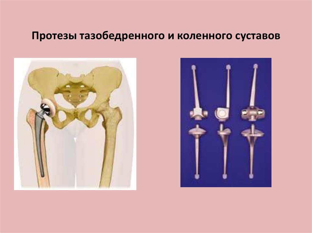 Протез тазобедренного сустава. Протез бедренной кости. Протезы тазобедренных и коленных суставов. Комбинированный эндопротез бедра. Протез бедренной кости при онкологии.