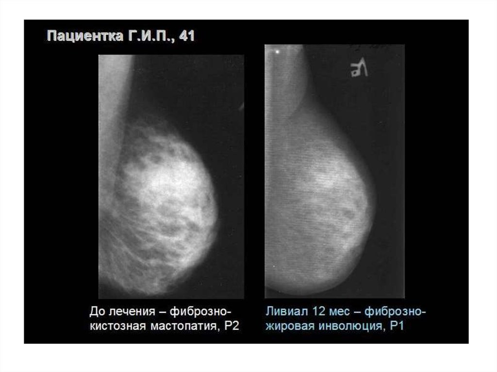 Фиброзно жировая инволюция молочной железы