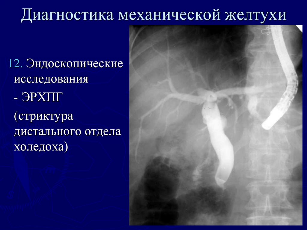 Механическая желтуха хирургия презентация