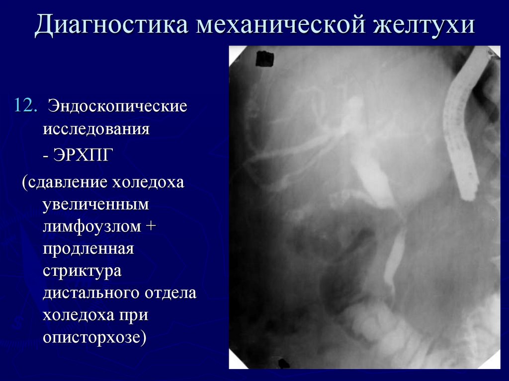 Механическая желтуха хирургия презентация