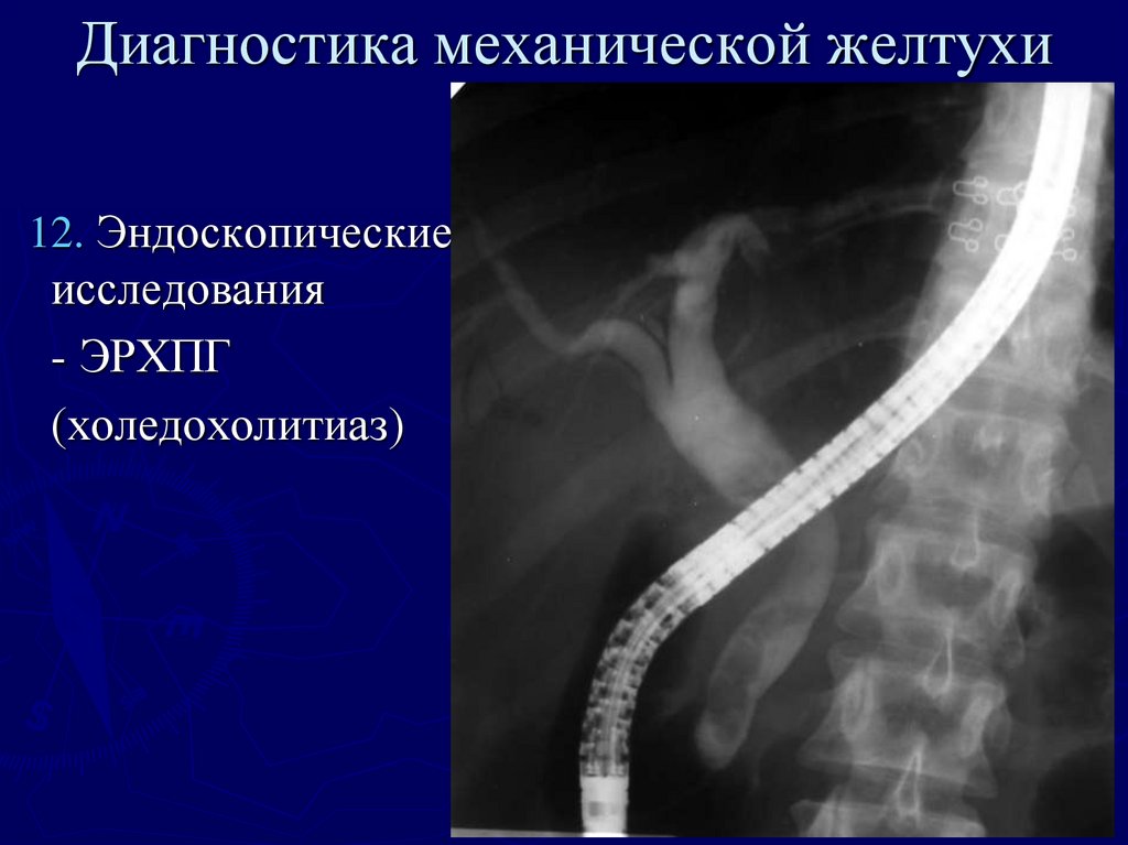 Механическая желтуха хирургия презентация