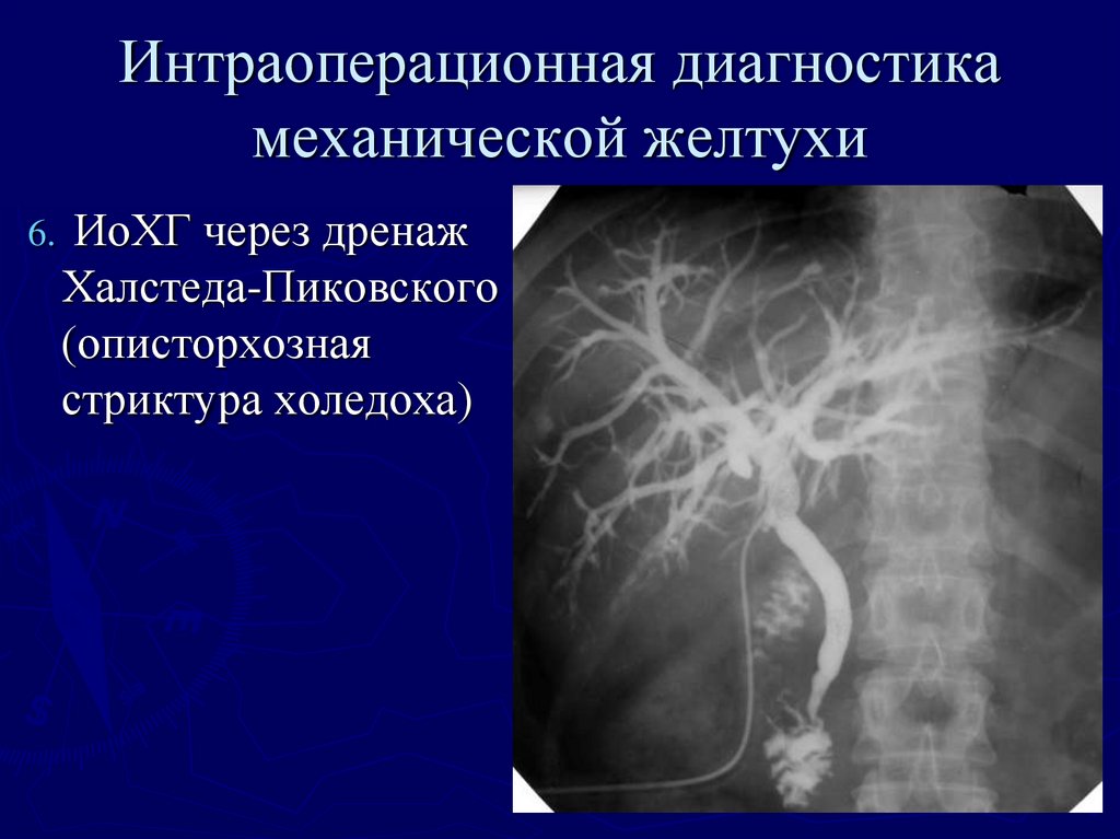 Обтурационная желтуха презентация