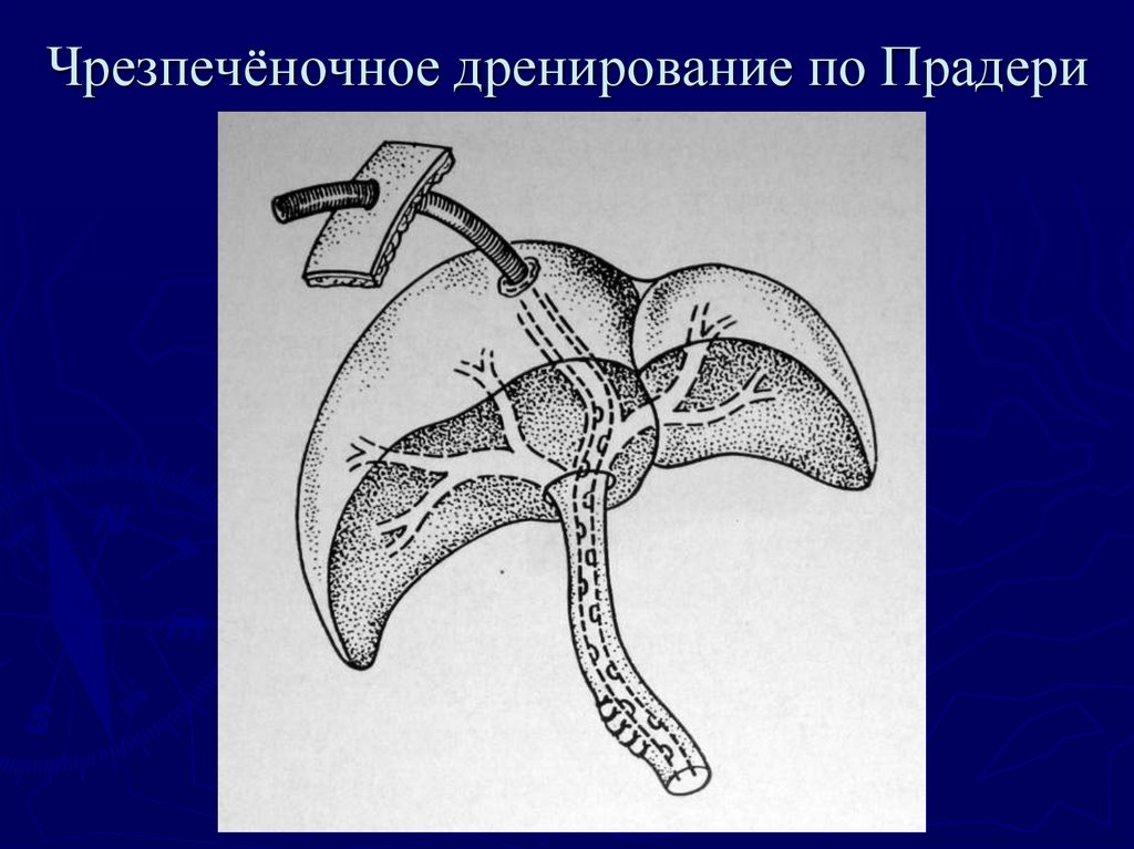 Механическая желтуха при раке