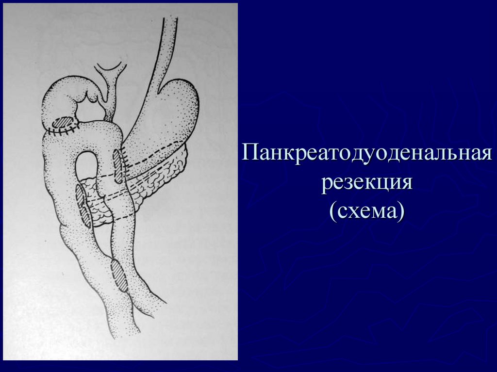 Панкреатодуоденальная резекция схема операции