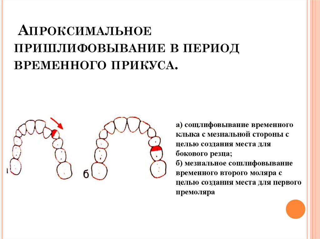 Избирательное пришлифовывание зубов презентация