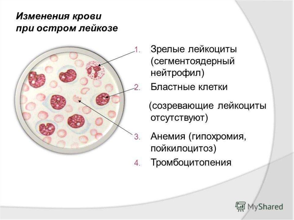 Лейкоз патофизиология презентация