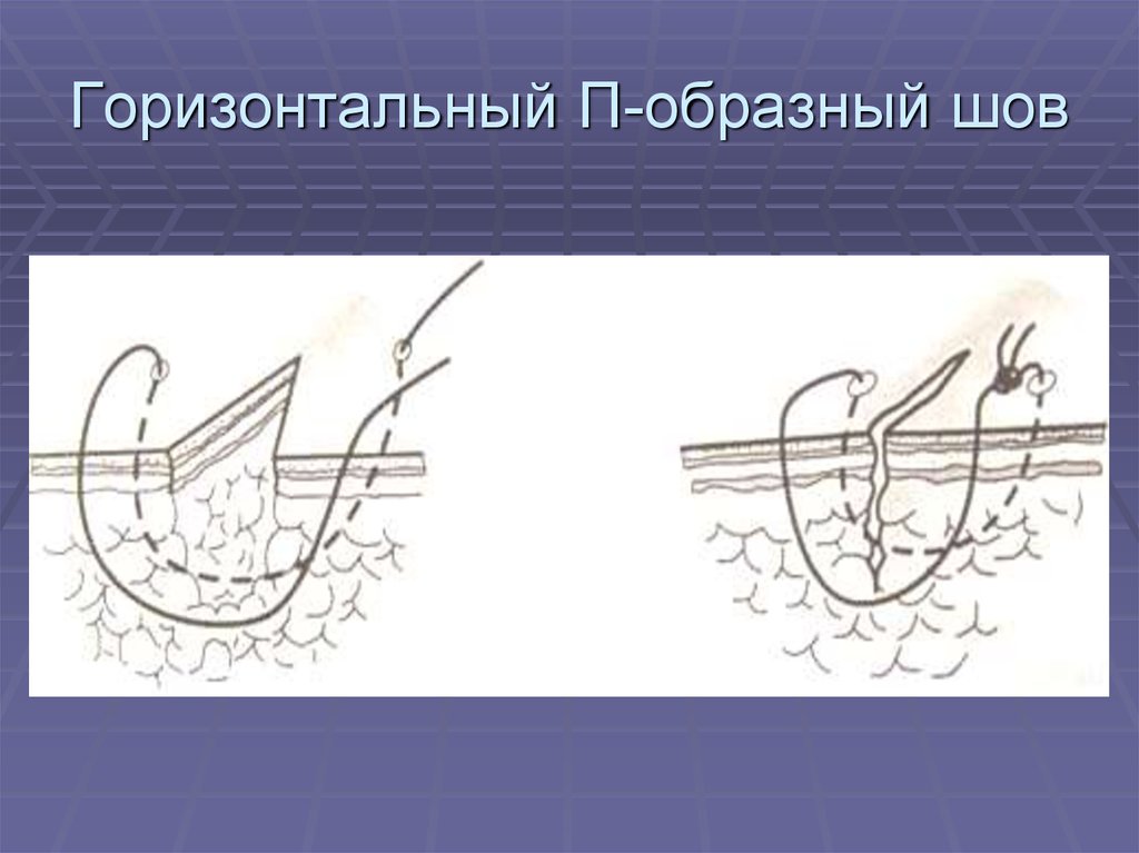 Горизонтальный шов. Горизонтальный матрацный (п-образный) шов. Горизонтальный и вертикальный матрацный шов. Узловой п образный шов. Узловой горизонтальный матрацный шов.