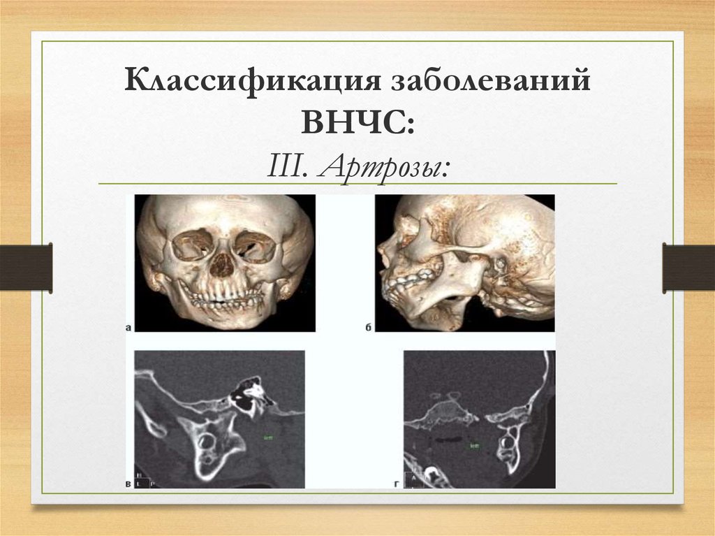 Презентация на тему анкилоз внчс