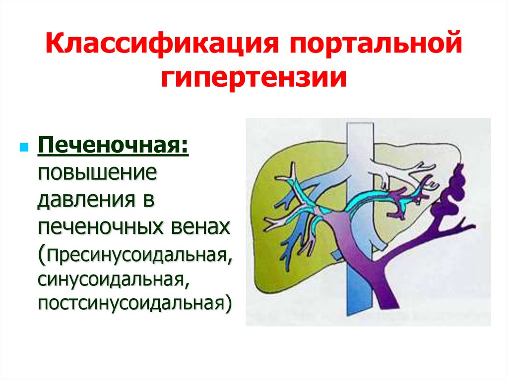 Лечение портальной гипертензии печени