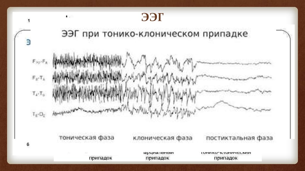 Ээг показывает эпилепсию. Патологические ритмы ЭЭГ при эпилепсии. ЭЭГ волны при эпилепсии. Эпилептические паттерны на ЭЭГ. Генерализованная эпилепсия ЭЭГ.