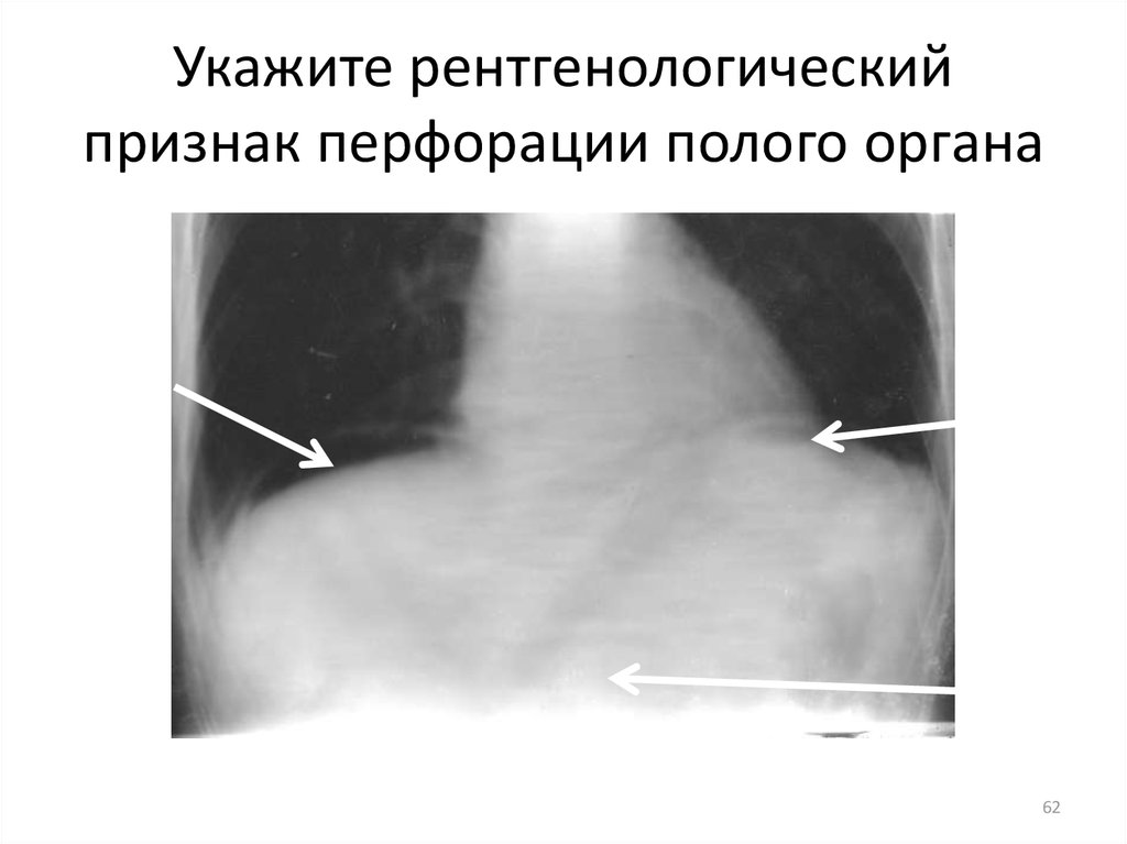 Перфорация полого органа