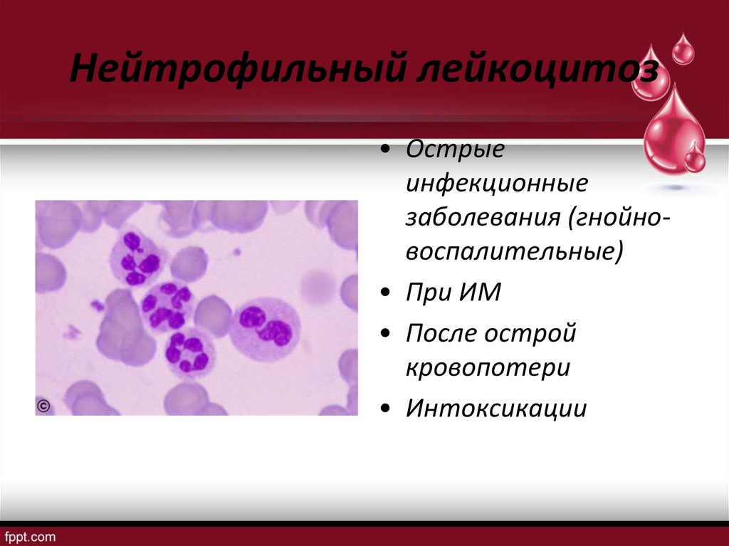 Лейкоцитоз нейтрофилы