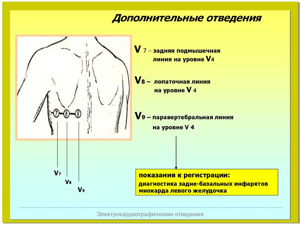 Дополнительные отведения экг презентация