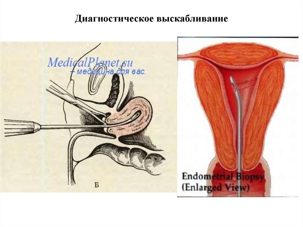 Выскабливание цервикального канала