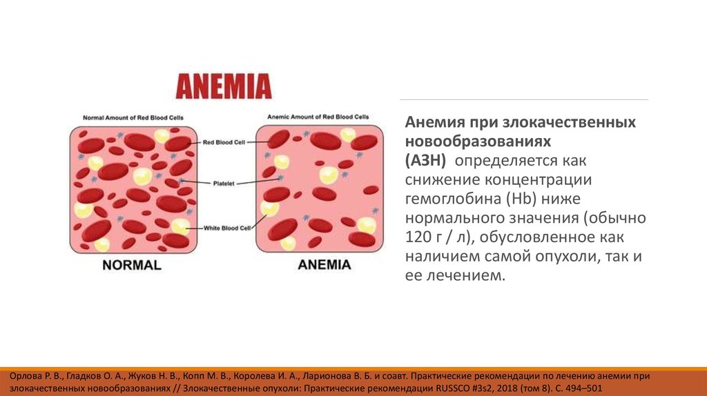 Анемия следствия. Анемия злокачественных новообразований. Анемия при новообразованиях. Анемия при злокачественных заболеваниях.