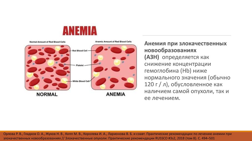 Анемия это что за болезнь у взрослых. Анемия при новообразованиях. Злокачественные новообразования анемия. Анемия при злокачественных заболеваниях.