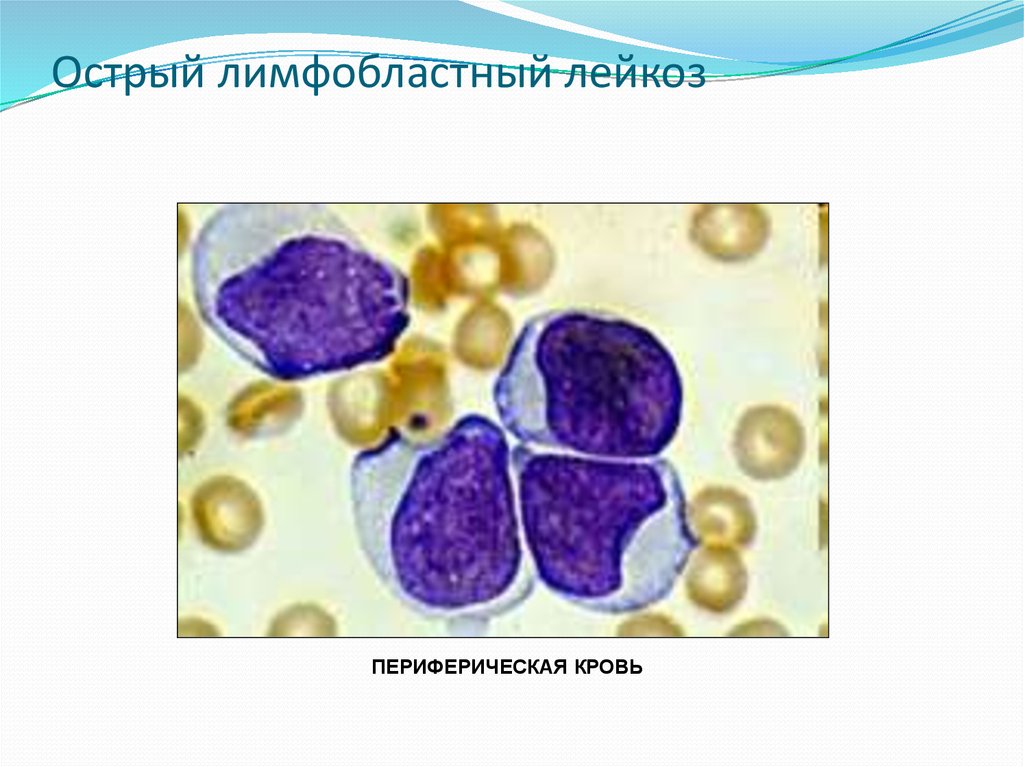 Лимфобластный лейкоз у взрослых