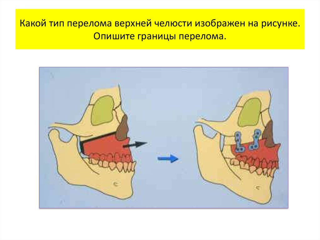 Верхний тип перелома верхней челюсти. Перелом верхней челюсти Лефор 2. Остеотомия верхней челюсти по типу Ле фор i. Клиновидная остеотомия челюсти.