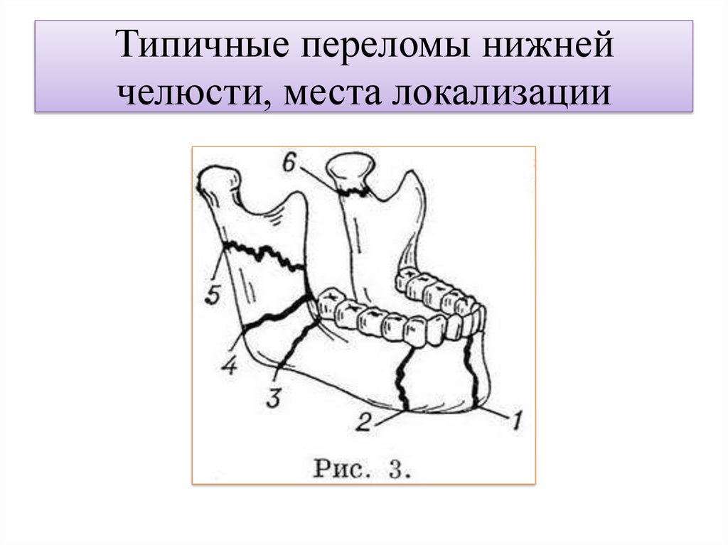 Переломы нижней челюсти стоматология презентация