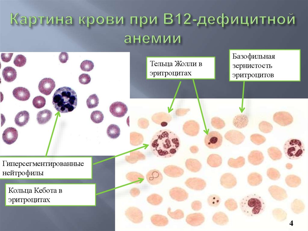 Кровь на б клетки. Периферическая кровь при в12 дефицитной анемии. В12 фолиеводефицитная анемия картина крови. Б12 дефицитная анемия мазок крови. Мазок крови при в12 фолиеводефицитной анемии.
