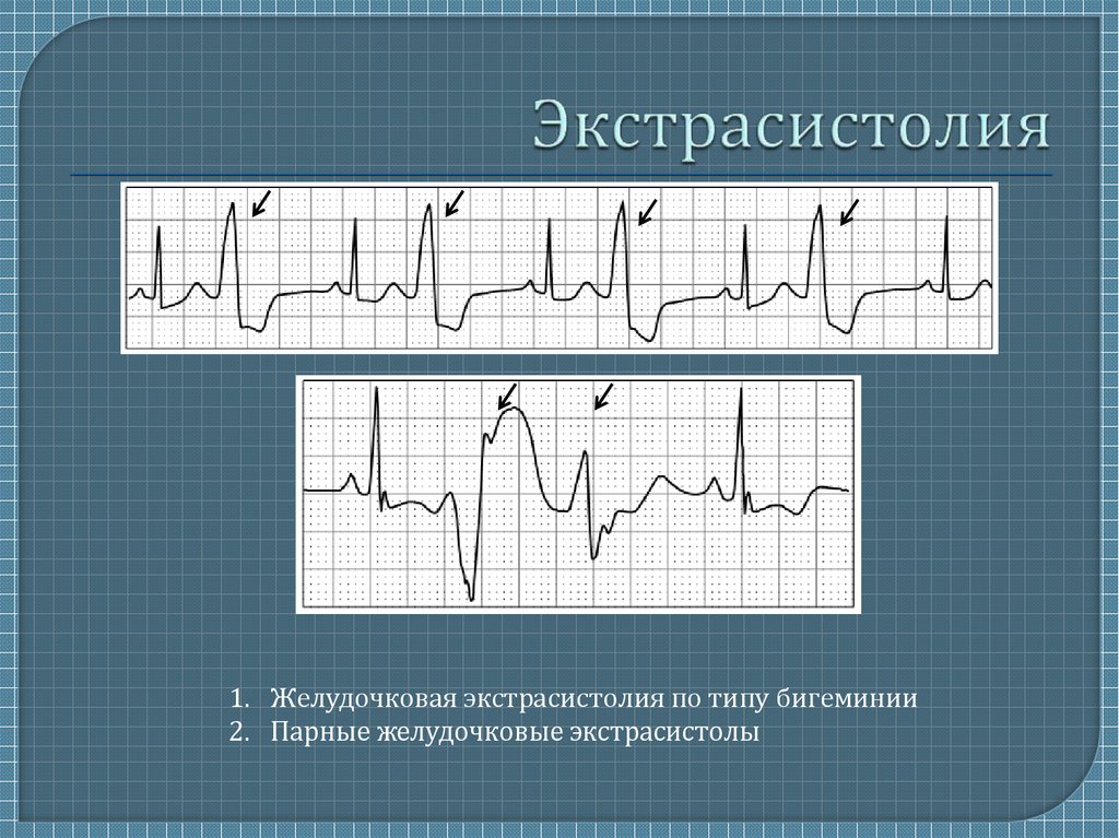 Желудочковая экс. Экстрасистолы на ЭКГ. Частые желудочковые экстрасистолы на ЭКГ. Что такое желудочковые экстрасистолы сердца. Желудочковая экстрасистолия типы.