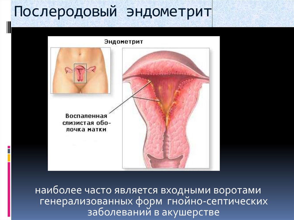 Воспаление внутренней оболочки матки. Метроэндометрит и эндометрит. Послеродовый Гнойный эндометрит. Послеродовой эндометрит Акушерство. Септический эндометрит макропрепарат.