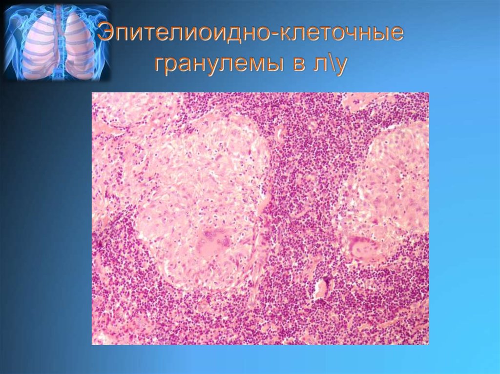 Эпителиоидно-клеточные гранулемы в л\у
