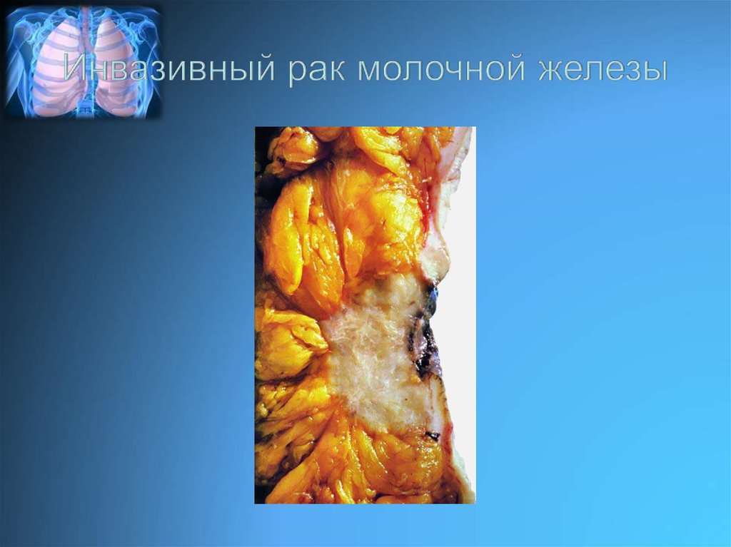 Инвазивный рак молочной железы