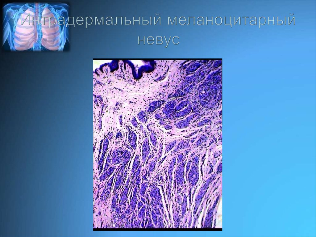 Интрадермальный меланоцитарный невус