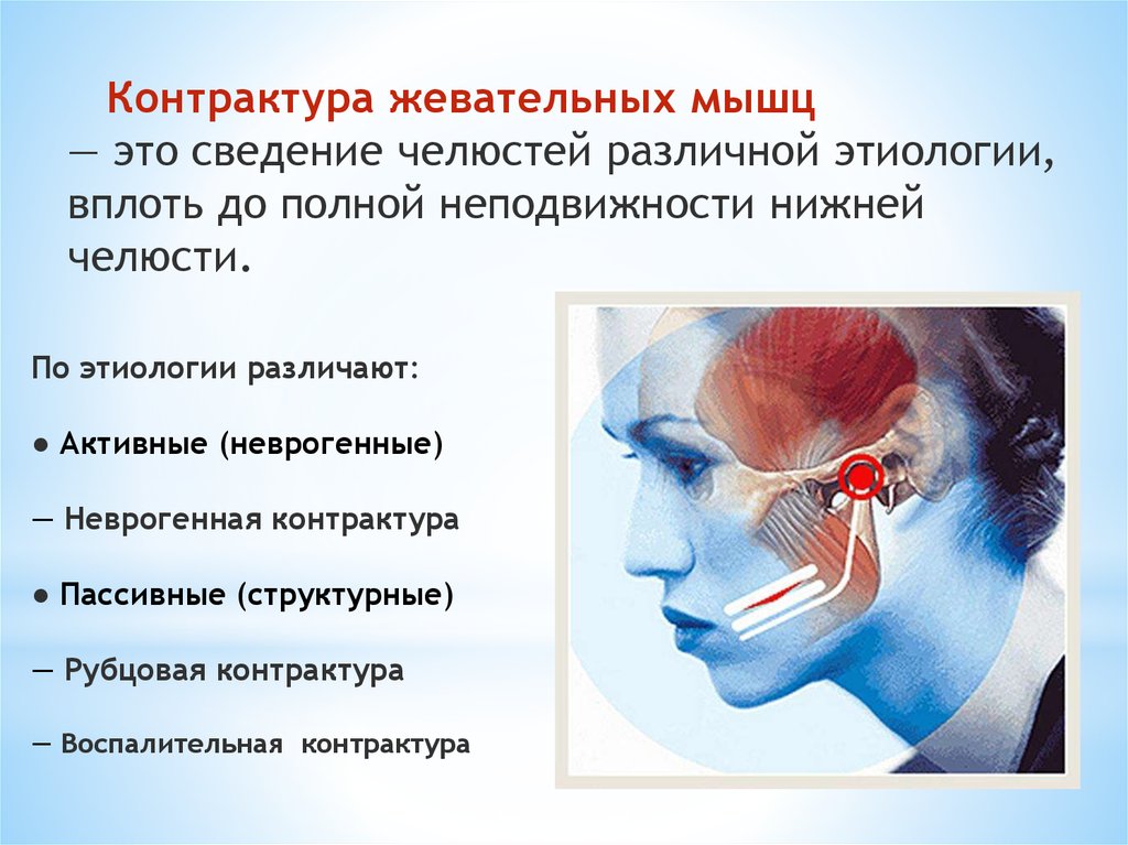 Контрактура нижней. Контрактура жевательных мышц. Контрактура мышц челюсти. Воспалительная контрактура жевательной мышцы.