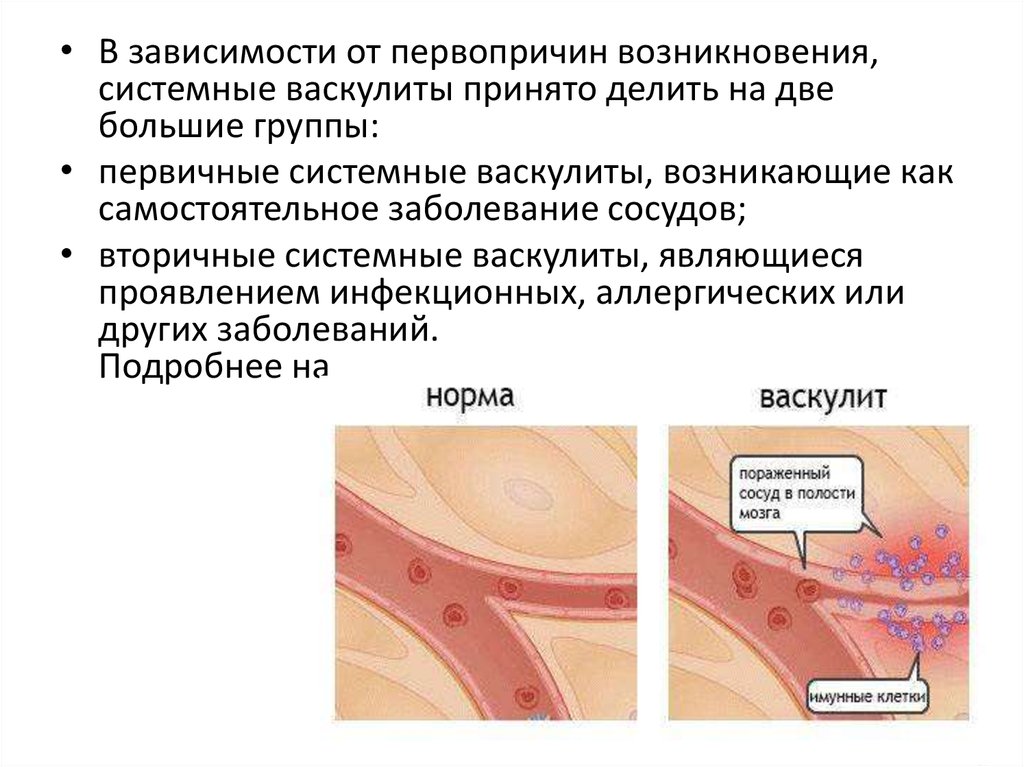 Васкулиты классификация диагностика симптомы. Системные васкулиты клинические рекомендации. Иммунокомплексный васкулит. Системные васкулиты классификация. Первичные системные васкулиты симптомы.