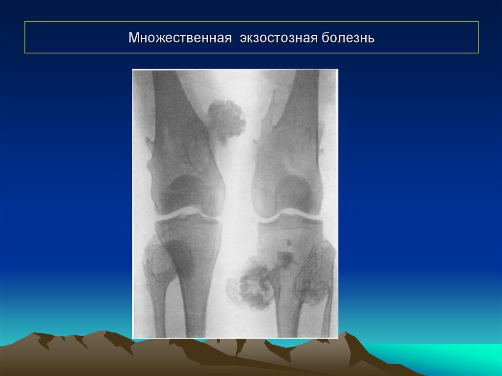 Опухоли костей презентация